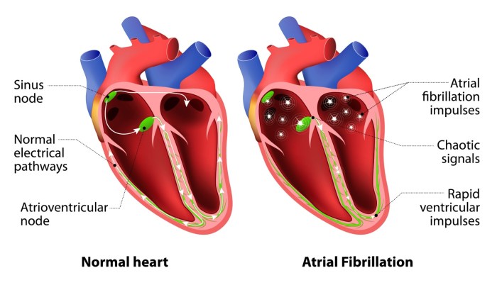 What does af mean in medical terms