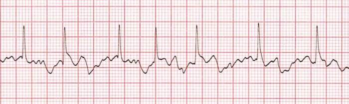 Atrial fibrillation ecg ekg fib patient training cardiac rhythms acls adult