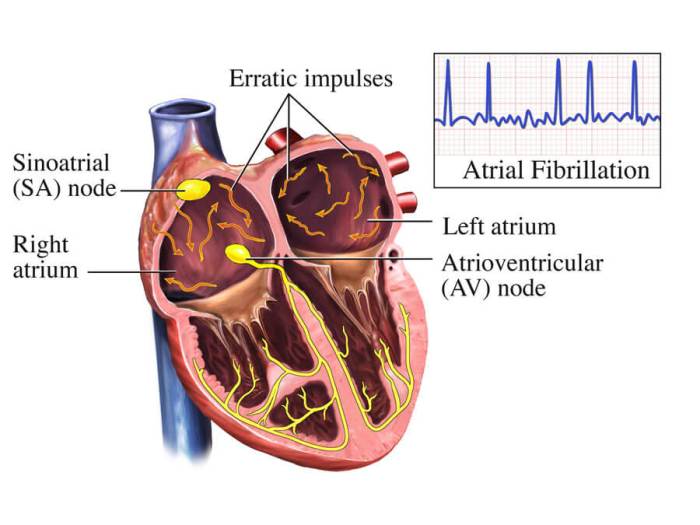 What does af mean in medical terms